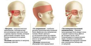 Пульсирующая боль в правой части головы: стороны, в одном месте